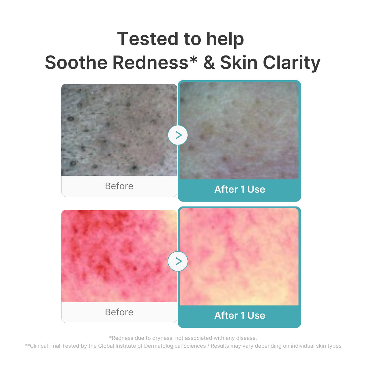 Azelaic Acid Capsule Foam Cleanser Z1